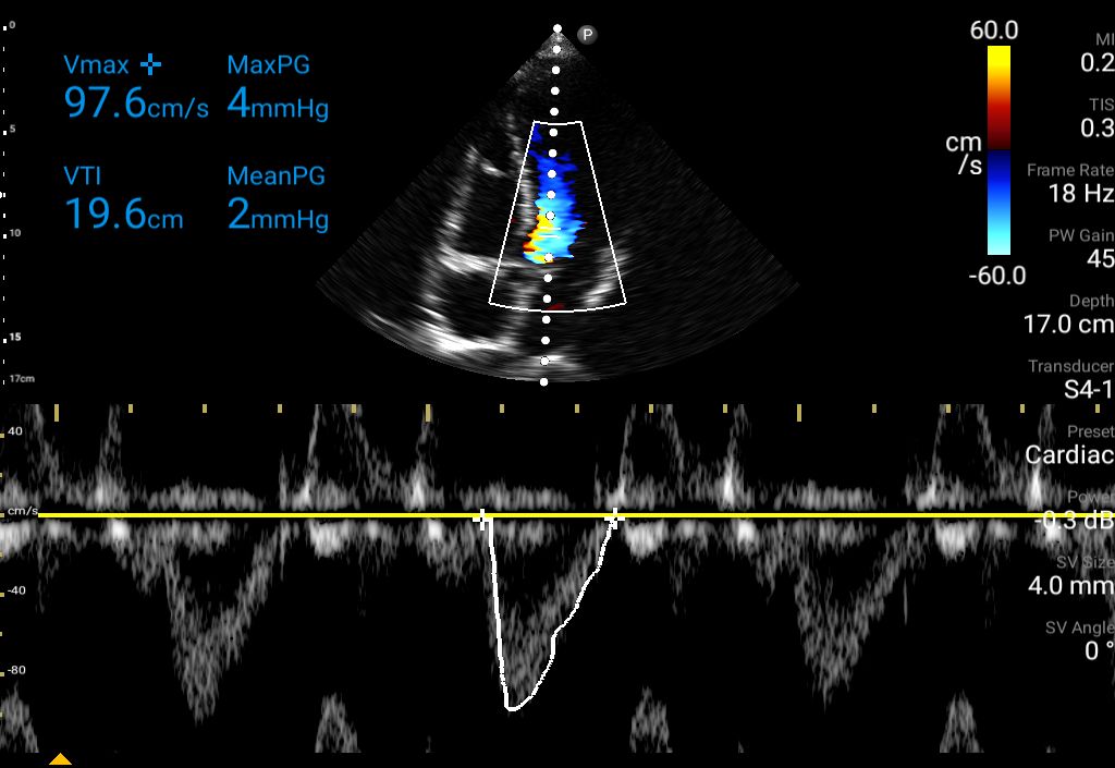 Cardiac ultrasound using color and Pulsed Wave Doppler shown using S4-1 transducer.