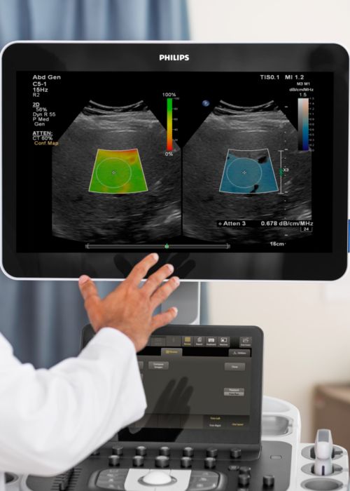 Ultrasound screen showing liver fat quantification measurement