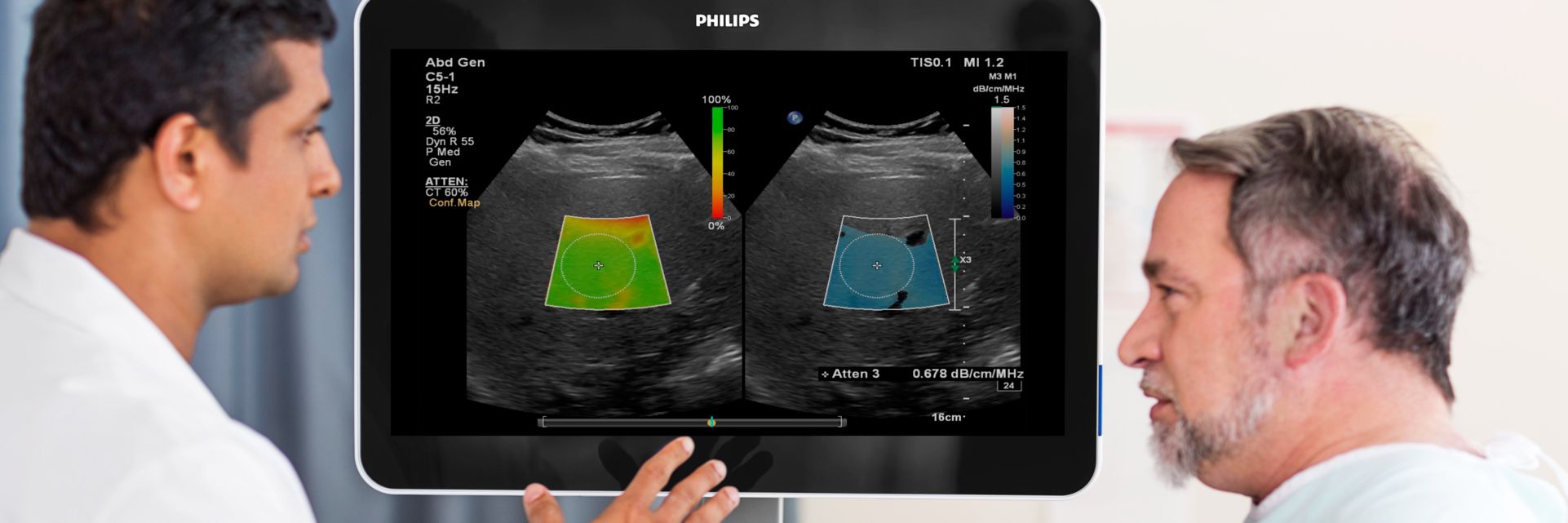 EPIQ Elite LFQ imaging