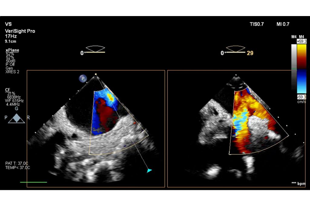 RF ablation using xPlane elevation tilt