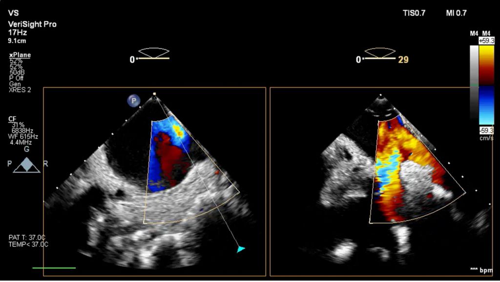 RF ablation using xPlane elevation tilt