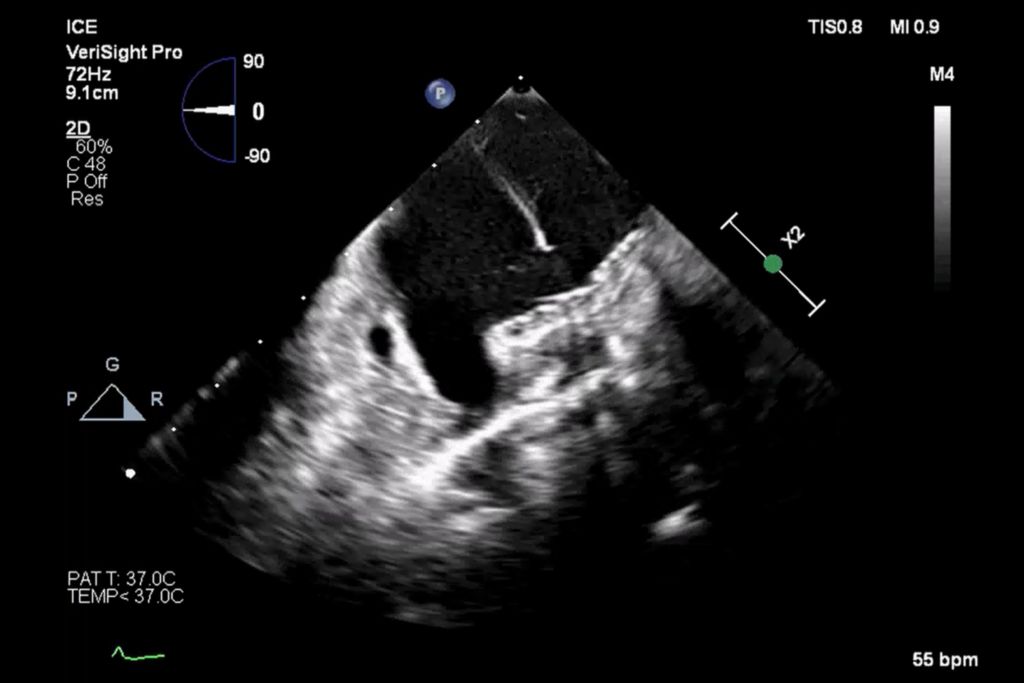 PFA device in the left pulmonary vein: 2D imaging mode - Image on file with Philips