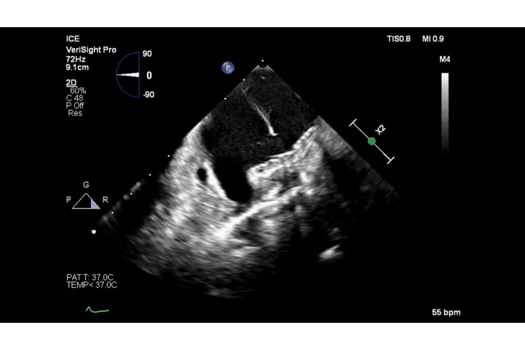 PFA device in the left pulmonary vein