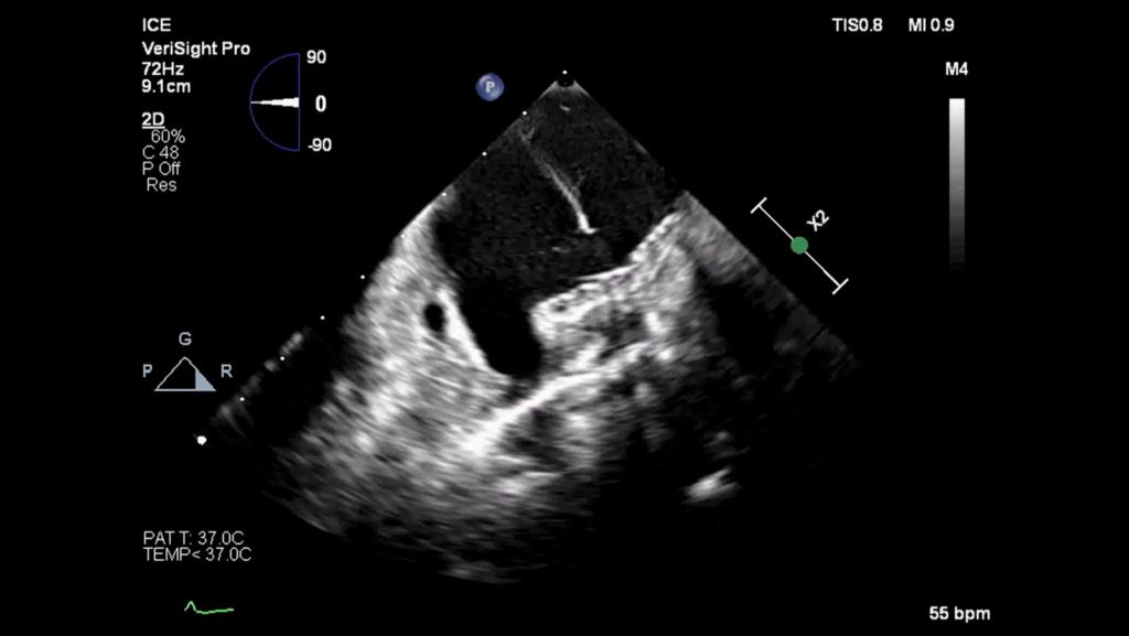PFA device in the left pulmonary vein