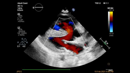 EPIQ CVx X5-1c VSD