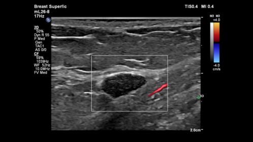 mL26-8 Breast