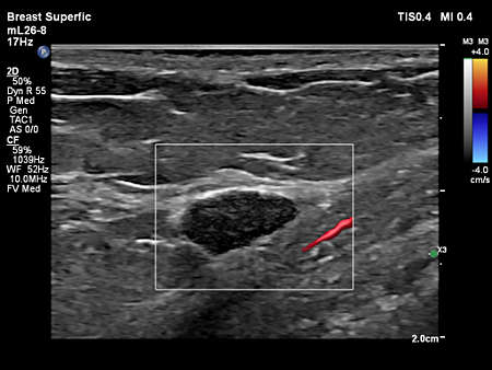 mL26-8 Breast