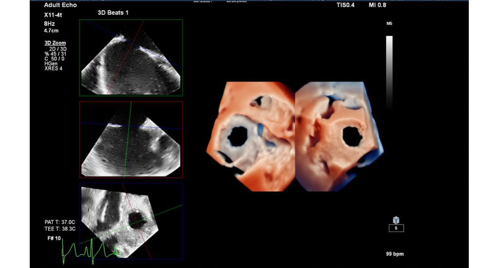 X11-4t Live 3D TEE TrueVue in Dual image