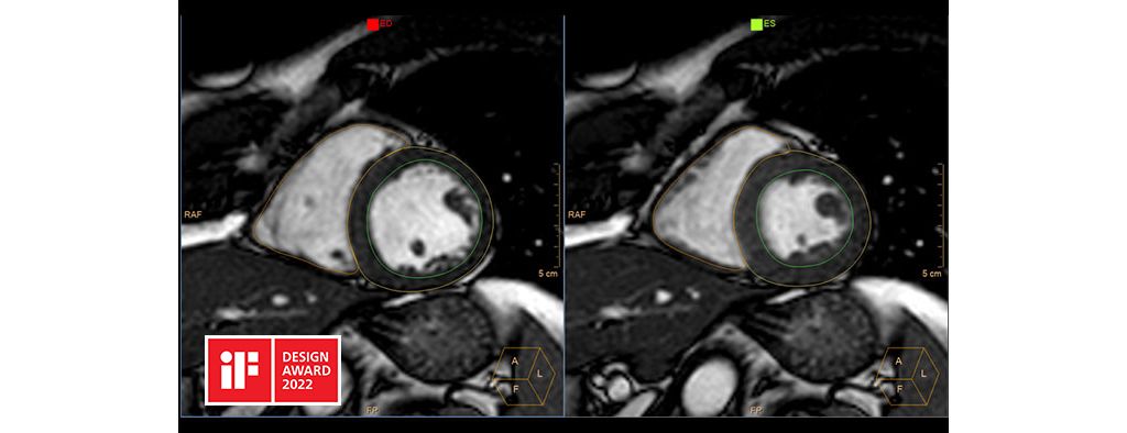 AI based RV/LV automatic segmentation for functional analysis​