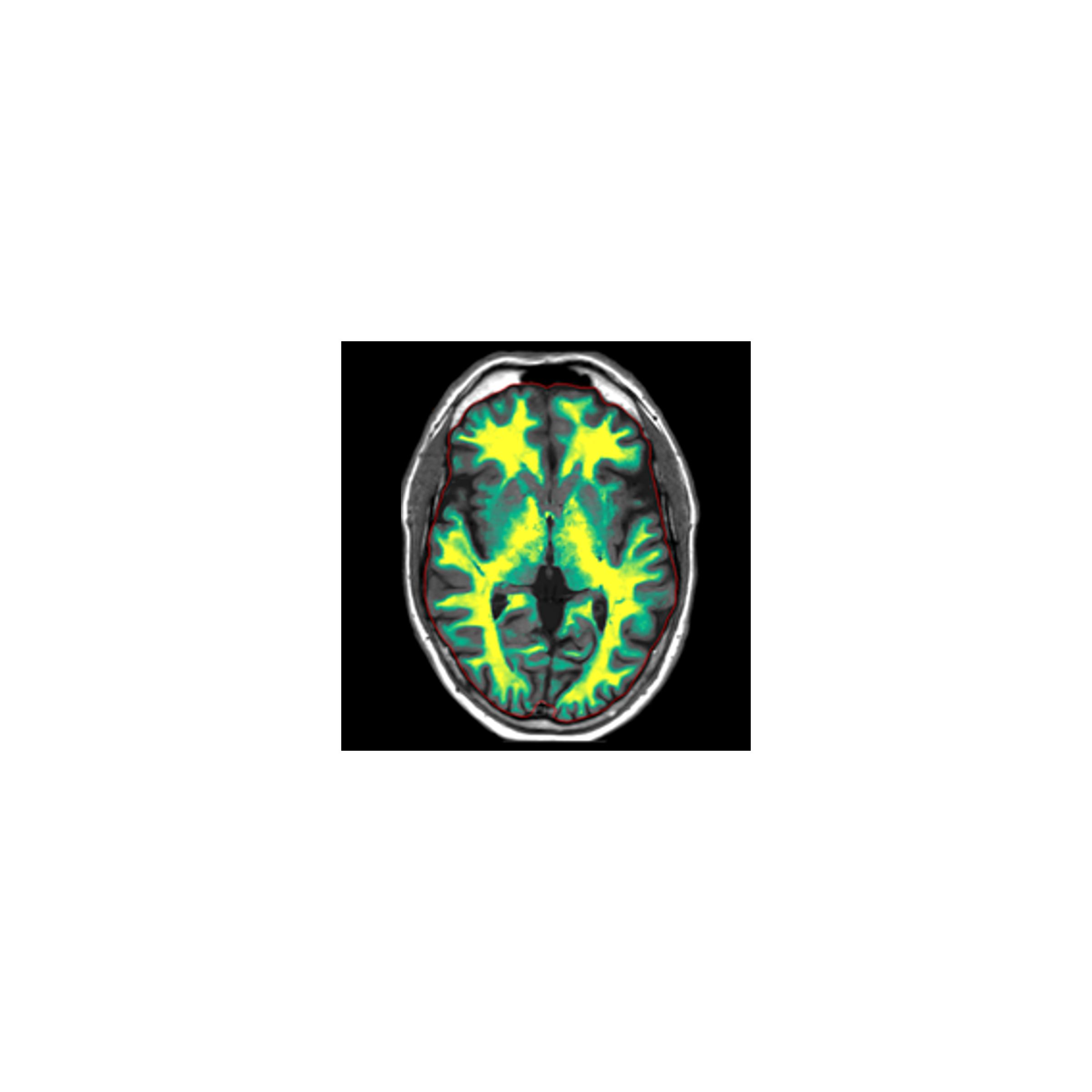 Scan of brain with SmartQuant neuro