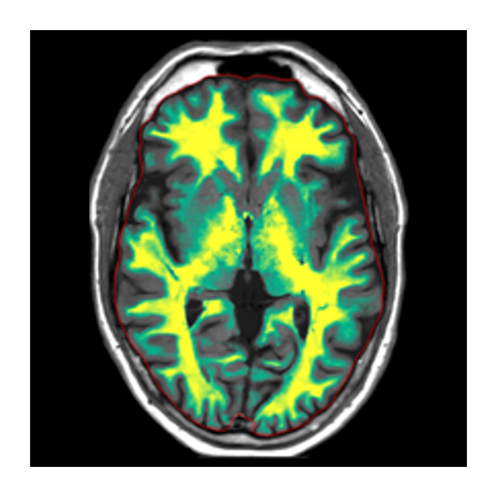 Clinical image of Smart Quant neuro