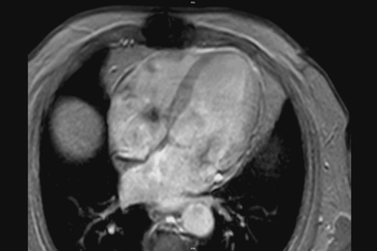 Cardiac MR – EPI cine 4 chamber view