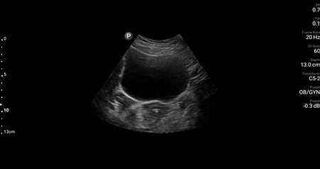 Urinary bladder transverse shown using C5-2 transducer.