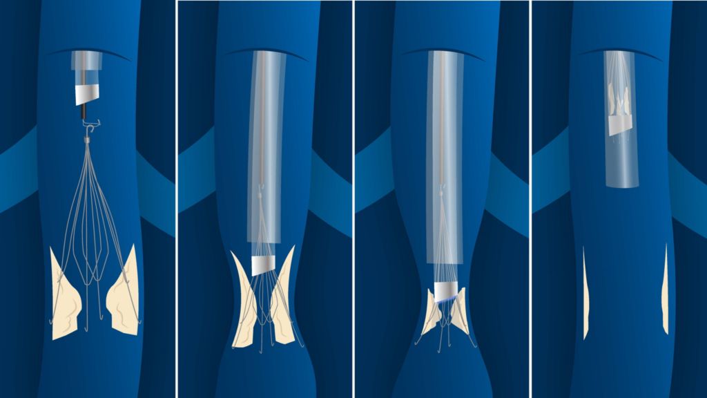 JAMA publishes first multi-center study on laser-assisted IVC filter removal