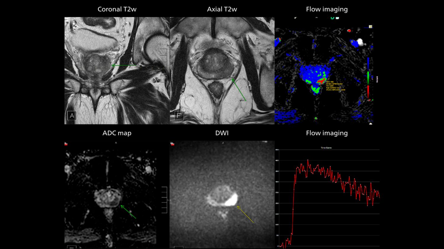 Multiparametric MRI of a classic peripheral zone lesion