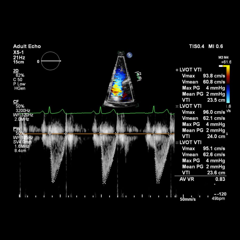 Auto Measure provides automation for robust, proven, reproducible cardiac quantification 