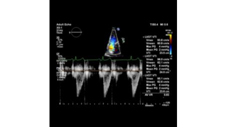 Auto Measure provides automation for robust, proven, reproducible cardiac quantification