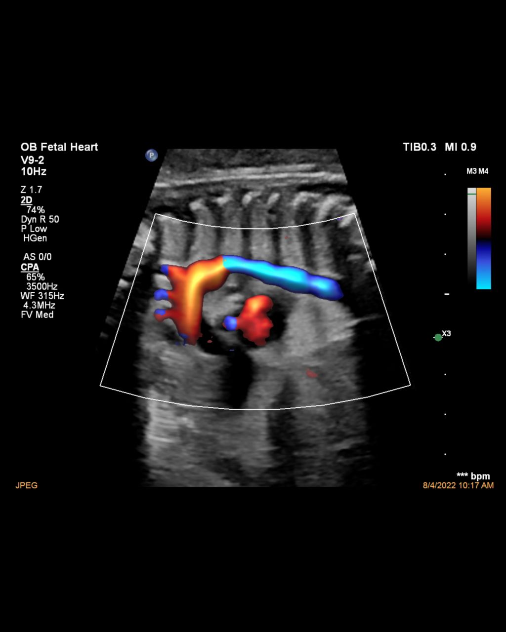 A clinical image shows a fetal heart on an ultrasound screen
