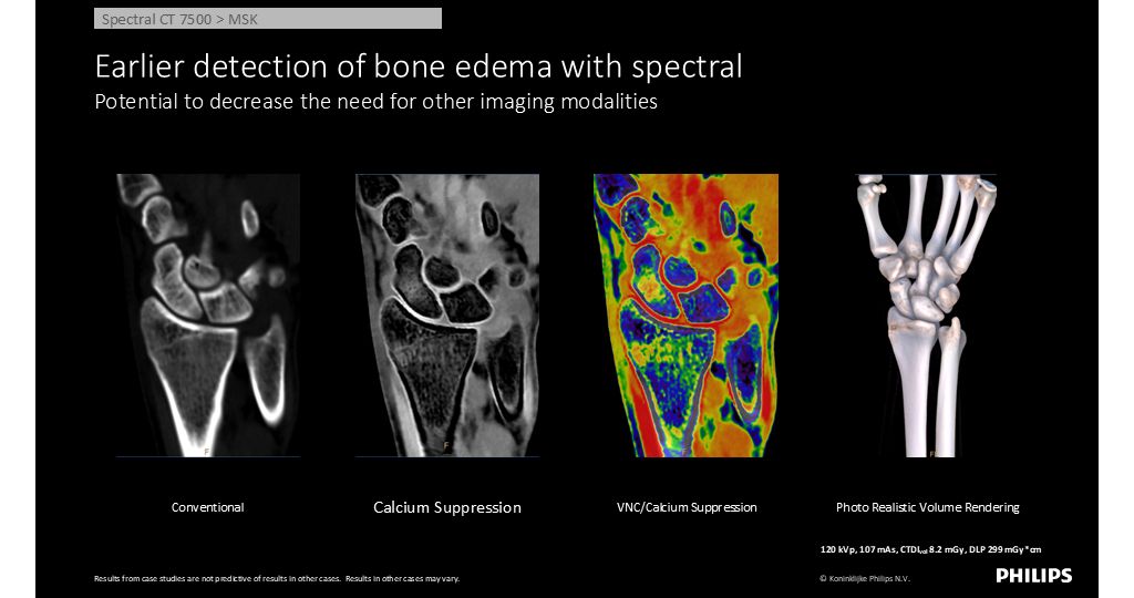 CT Spectral 7500 MSK  - Earlier detection of bone edema with spectral