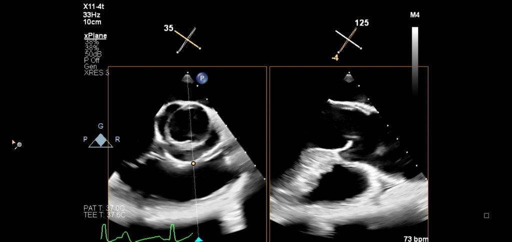 X11-4t mini 3D TEE Bicuspid Aortic valve