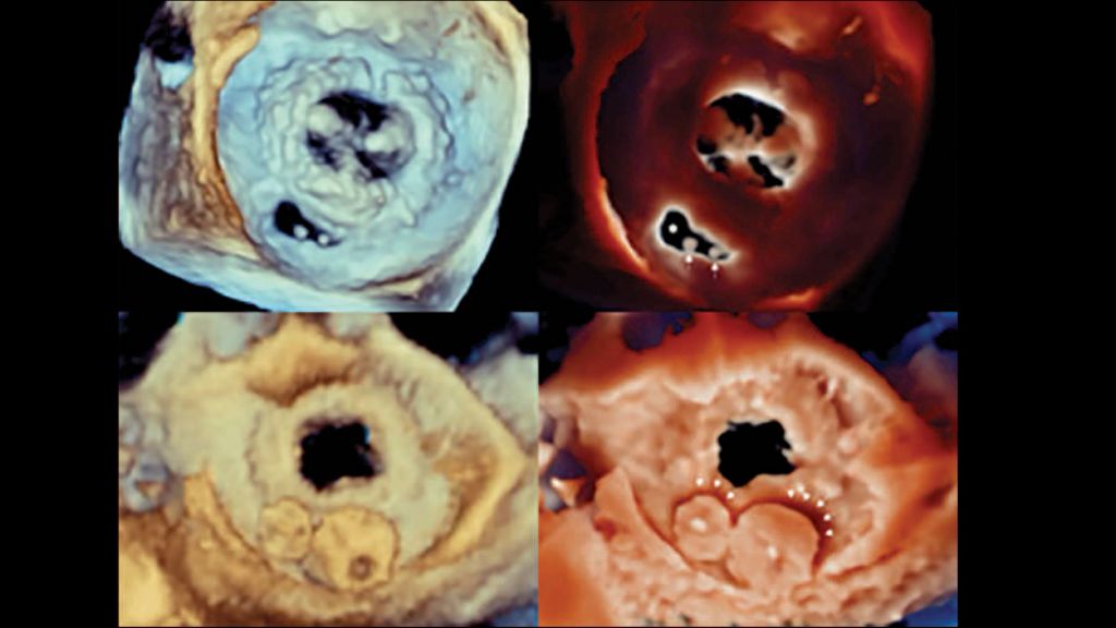 Clinical image – TrueVue - shadows projected by the vascular plugs on the mitral bioprosthesis