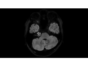 DWI XD TSE - Brain MR clinical application