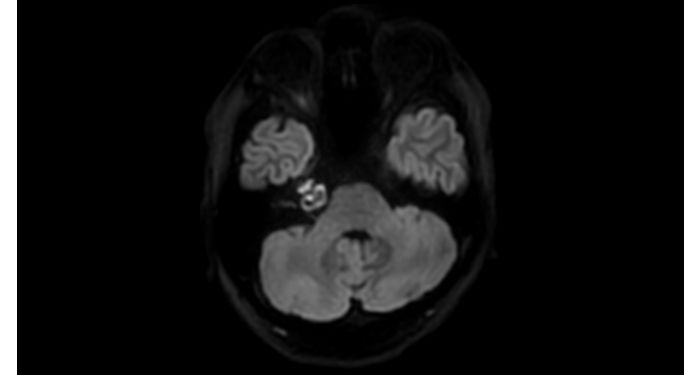 DWI XD TSE Brain MR clinical application | Philips