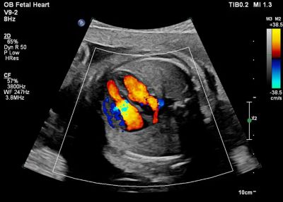 Affiniti ultrasound showing fetal heart monitoring
