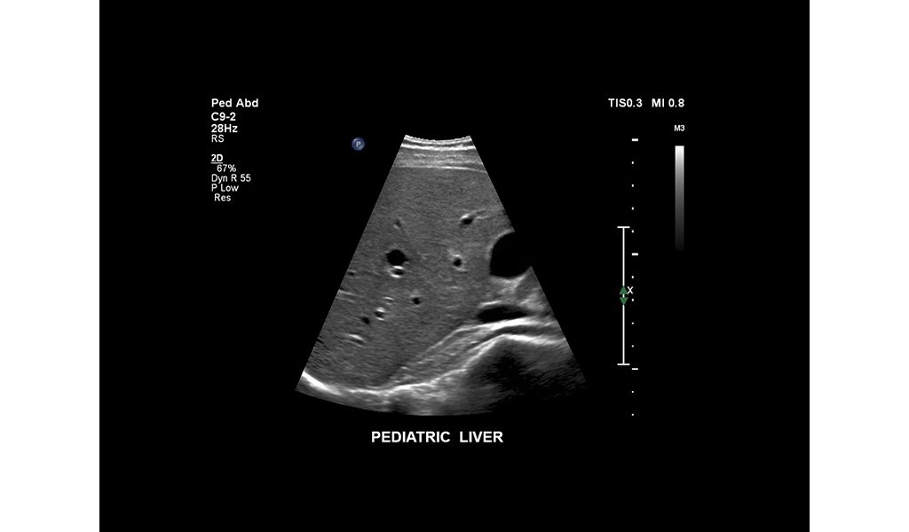 Pediatric liver