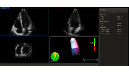 Advanced Cardiac 3D Quantification (3DQA)