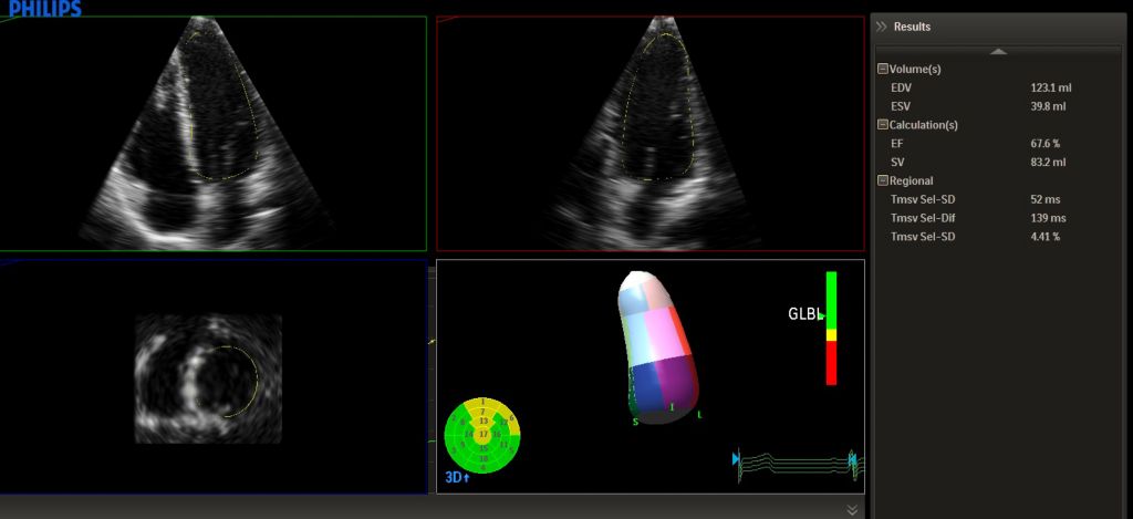 Advanced Cardiac 3D Quantification (3DQA)