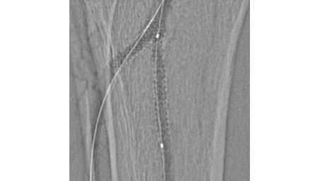 StentBoost Vascular enhances stents in larger vasculature