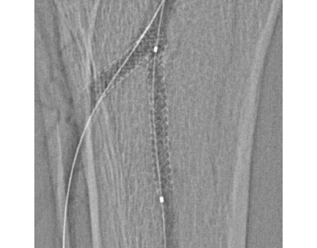 StentBoost Vascular