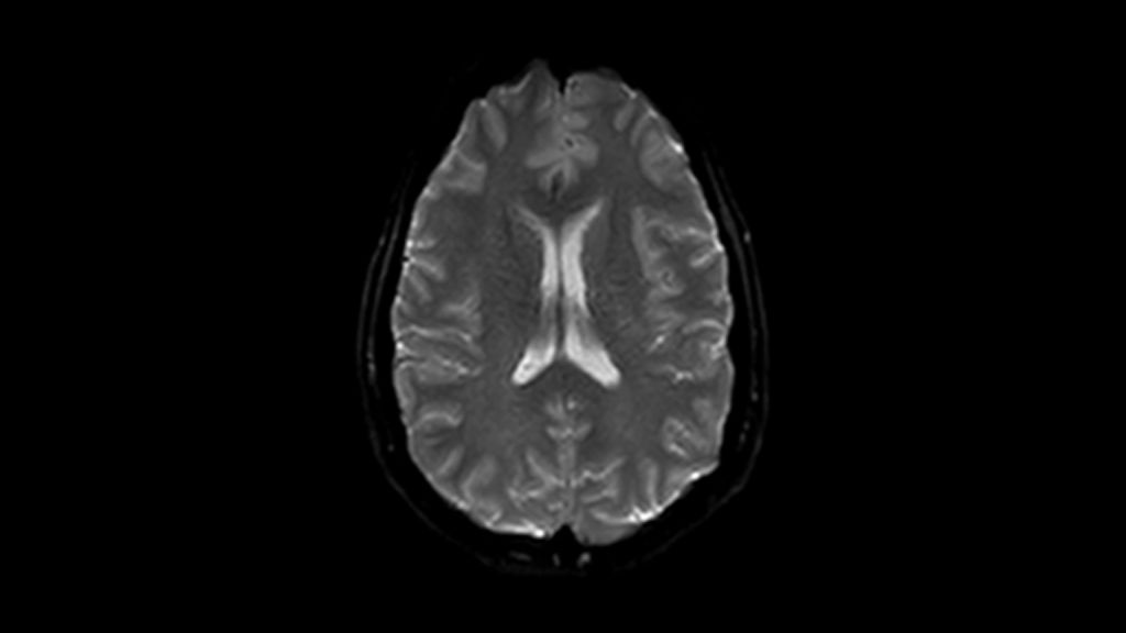 DWI b0 clinical image of the brain