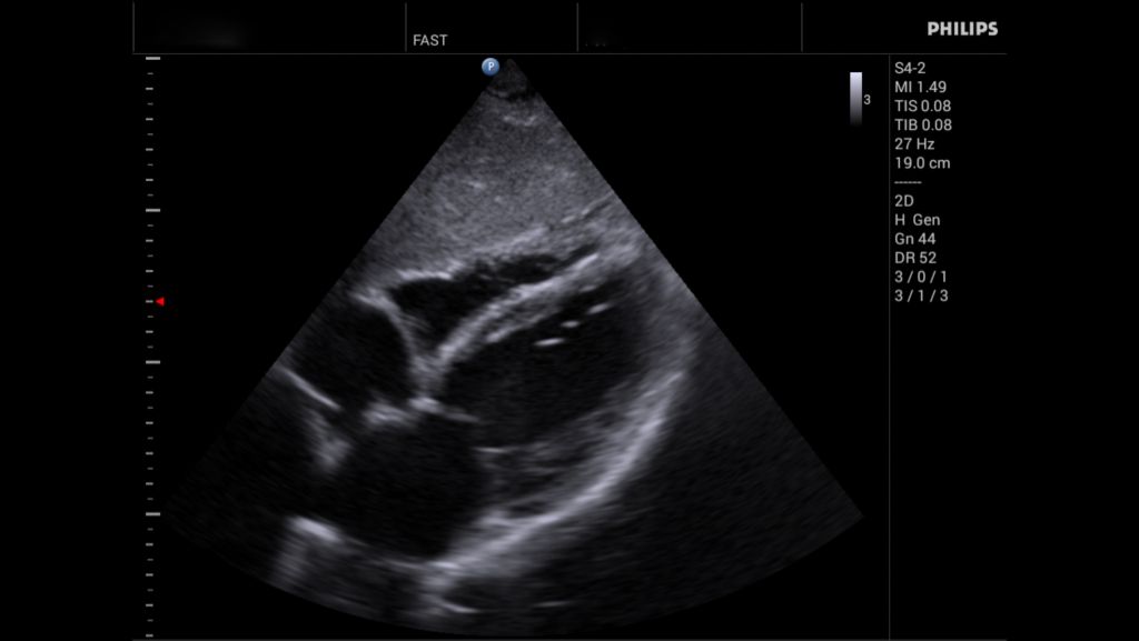 S4-2 Subxiphoid 4 Chamber