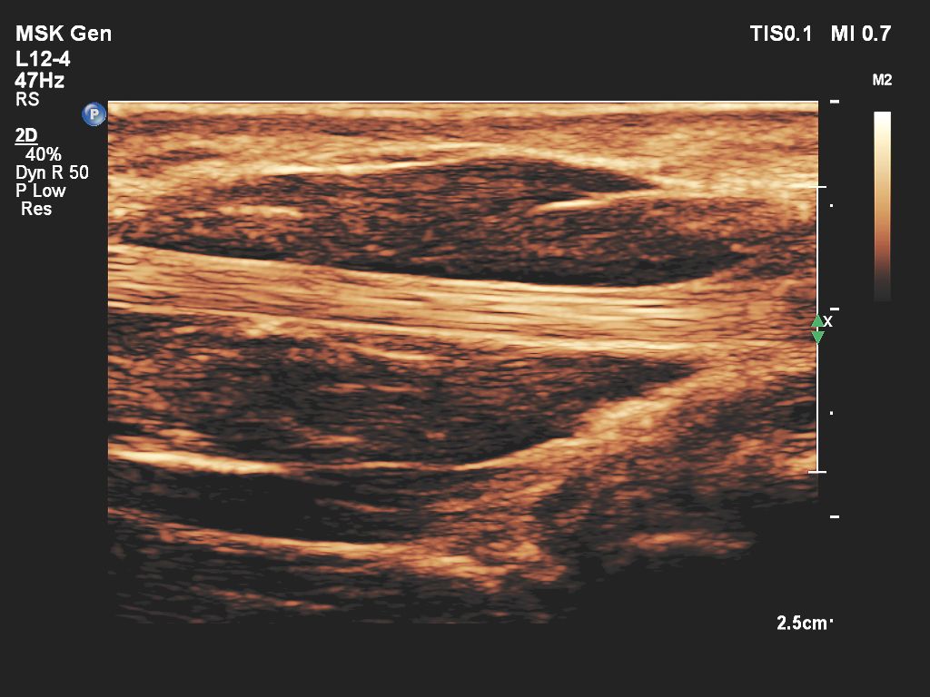 Affiniti 30 ultrasound clinical image MSK
