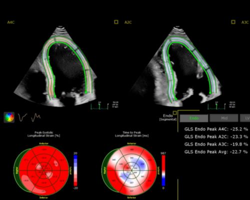 Echo Auto strain screen capture image