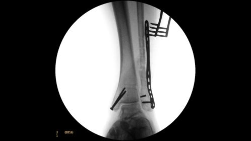Clinical Image Philips BV Mobile C-arm Pulsera