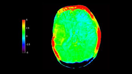 Diagnostic fiable en neuro-oncologie 