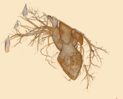 Photon counting CT clinical image