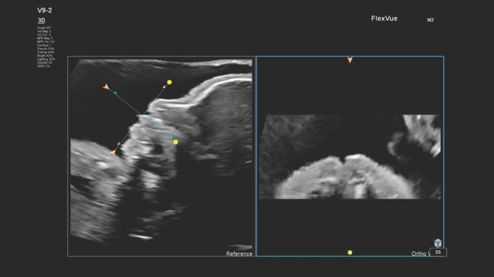 Figure 5 Orthogonal View line (Blue) demonstrating the corresponding transverse plane and fetal palate
