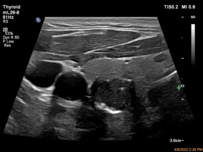 Ultraschall Web nSight Philips Schilddrüse