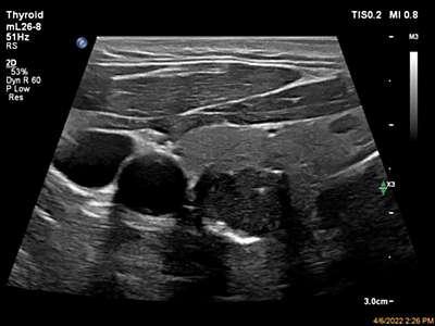 Ultrasound web nSight Philips Thyroid