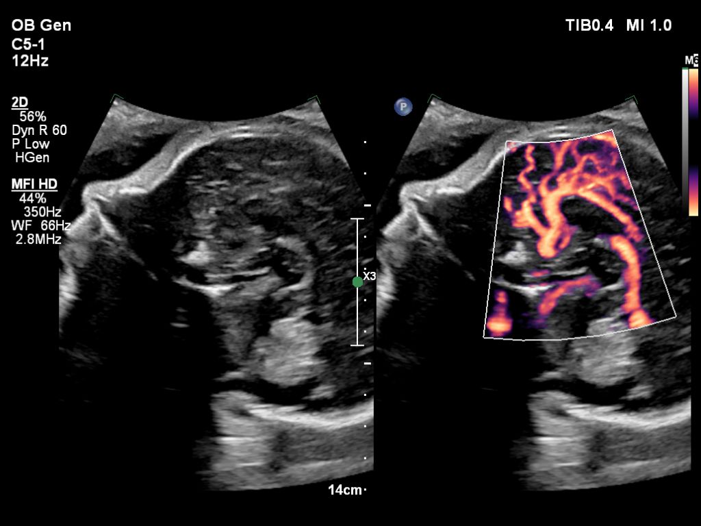 Fetal brain pericallosal artery with MFI HD using C5-1 transducer