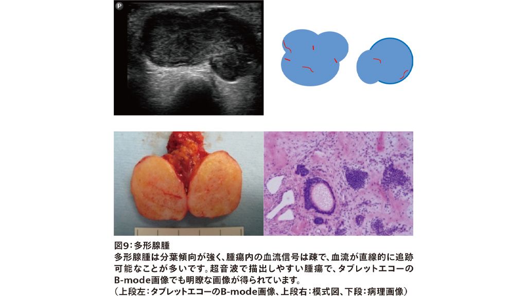 図9：多形腺腫