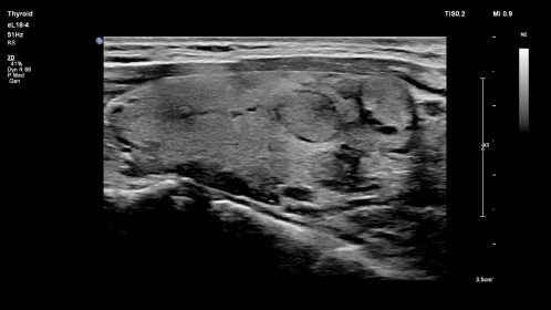 eL18-4 Thyroid