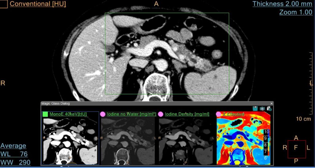 Using Magic Glass to view a Pancreatic Lesion