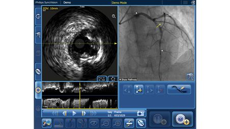 Localizzazione della co-registrazione IVUS su SyncVision