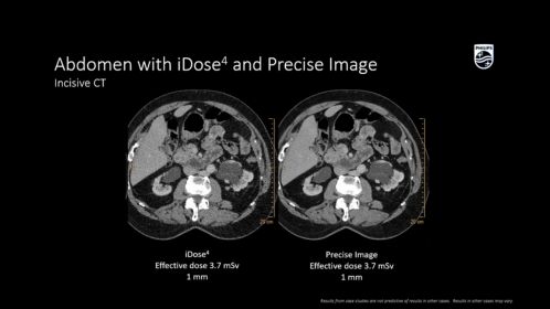 Incisive CT Abdomen avec iDose4 et Precise Image