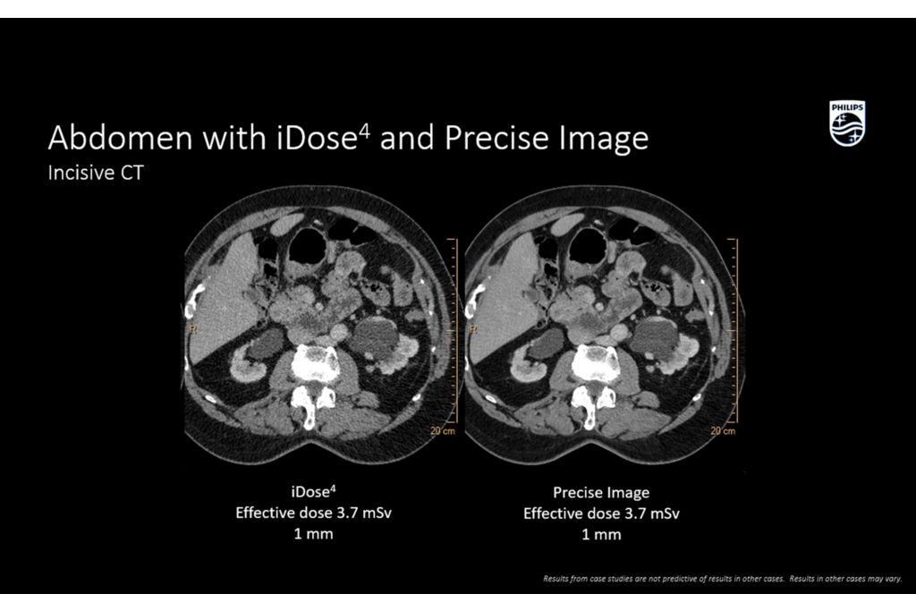 Incisive CT Abdomen with iDose4 and precise image